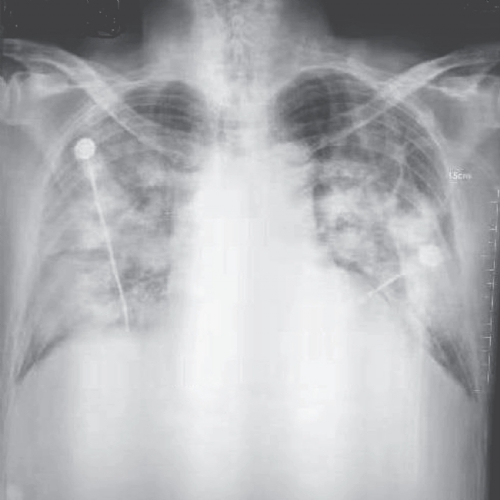 SAIBA O QUE � O NOVO CORONAV�RUS E ACOMPANHE O N�MERO DE CASOS EM TEMPO REAL